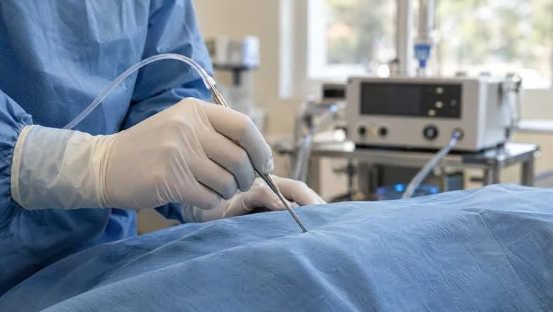 Surgeon's gloved hands holding a fine argon plasma probe with gas tubing over sterile drapes for Argo Plasma skin tightening in London