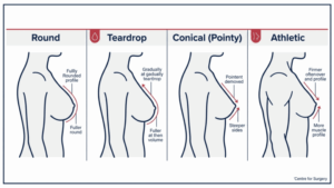 Diagram showing the normal spectrum of natural breast shapes at Centre for Surgery London — round, teardrop, conical (pointy), and athletic