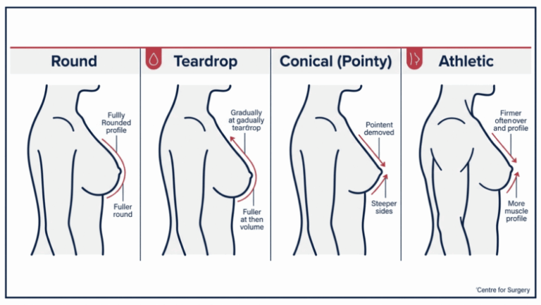 Diagram showing the normal spectrum of natural breast shapes at Centre for Surgery London — round, teardrop, conical (pointy), and athletic
