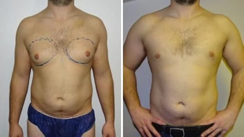Chest fat (pseudogynaecomastia) before and after liposuction, front view, before on the left and after on the right, Centre for Surgery patient