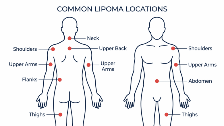 Common lipoma locations on the body diagram showing front and back view with labelled sites including shoulders upper back neck arms abdomen and thighs — Centre for Surgery London