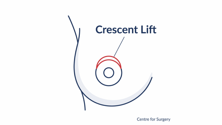 Diagram of the crescent breast lift incision pattern at Centre for Surgery London, showing a small half-moon incision along the top edge of the areola