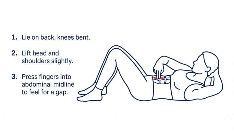 Medical diagram showing how to self-test for diastasis recti by lying on back with knees bent and pressing fingers into the abdominal midline to feel for a gap