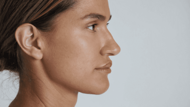 Side profile showing a gentle convex curve along the nasal bridge — dorsal hump assessment and treatment, Centre for Surgery London