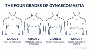 Diagram of the four grades of gynaecomastia — Grade 1 mild with no excess skin, Grade 2 moderate with minimal skin excess, Grade 3 severe with mild sagging, Grade 4 severe with significant sagging