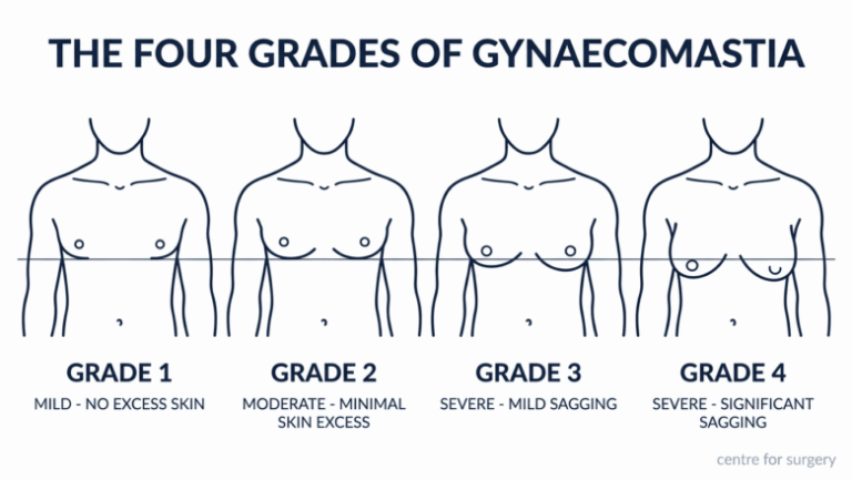 Diagram of the four grades of gynaecomastia — Grade 1 mild with no excess skin, Grade 2 moderate with minimal skin excess, Grade 3 severe with mild sagging, Grade 4 severe with significant sagging