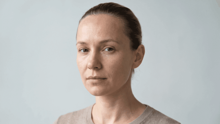 Hair swept back showing natural hairline position and forehead height, the proportions assessed in hairline lowering surgery at Centre for Surgery London