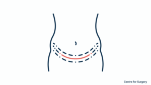 No-drain tummy tuck London — Centre for Surgery