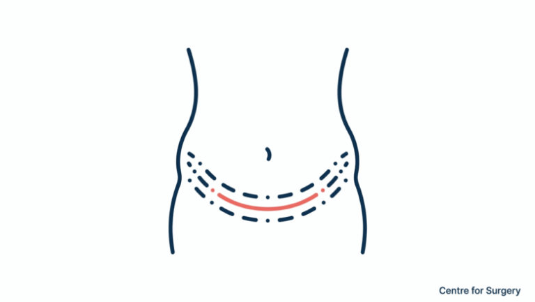 No-drain tummy tuck London — Centre for Surgery