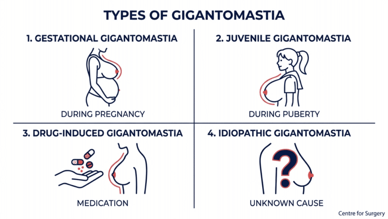 Diagram showing four types of gigantomastia: gestational during pregnancy, juvenile during puberty, drug-induced from medication, and idiopathic with unknown cause