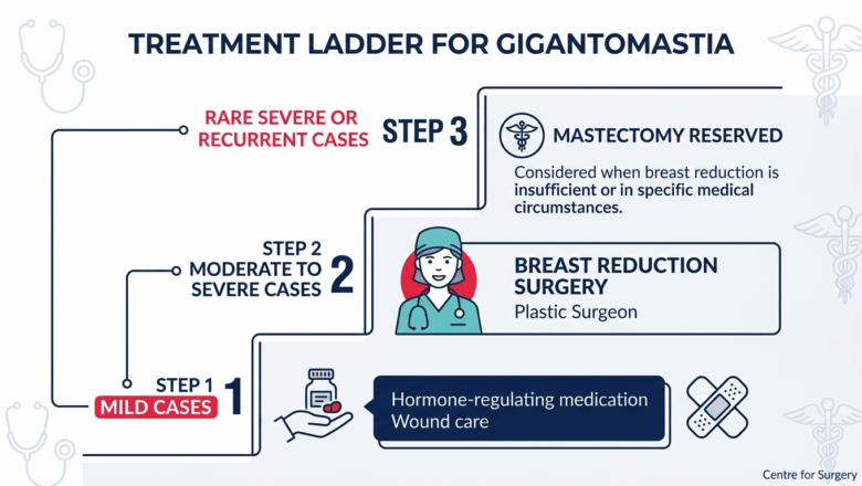 Treatment ladder for gigantomastia showing three escalating steps: hormone-regulating medication for mild cases, breast reduction surgery for moderate to severe cases, and mastectomy reserved for rare severe or recurrent cases