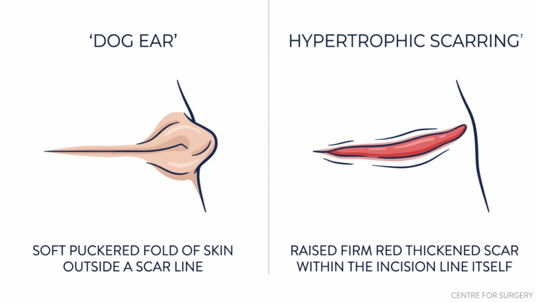 Two-panel comparison showing a dog ear as a soft puckered fold of skin outside the scar line, versus hypertrophic scarring as a raised firm red thickened scar within the incision itself