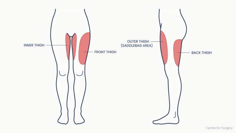 Diagram showing thigh liposuction treatment zones: inner thigh, outer thigh saddlebags, front and back thigh