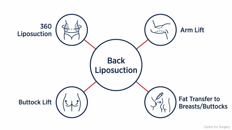 Diagram showing back liposuction commonly combined with 360 liposuction, arm lift, buttock lift and fat transfer