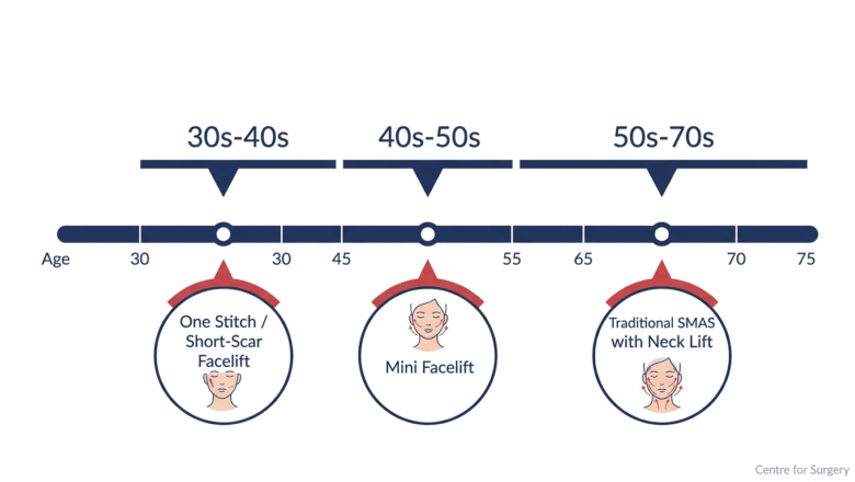 Timeline chart mapping age decades to the appropriate facelift procedure type