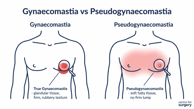 Diagram comparing true gynaecomastia glandular tissue versus pseudogynaecomastia fatty tissue in the male chest