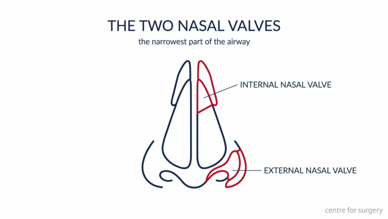 Diagram of the internal nasal valve and the external nasal valve at the nostril, the narrowest parts of the airway, Centre for Surgery London