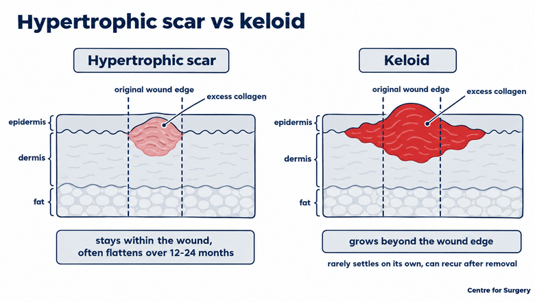Hypertrophic Scar vs Keloid Diagram | Scar Treatment London | Centre for Surgery Diagram comparing a hypertrophic scar that stays within the original wound edges with a keloid that grows beyond them into healthy skin
