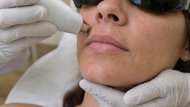 Gloved practitioner holding a laser handpiece near a woman's upper lip during LipLase lip laser treatment in London