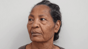 Woman in her forties considering treatment for malar bags and festoons — Centre for Surgery London
