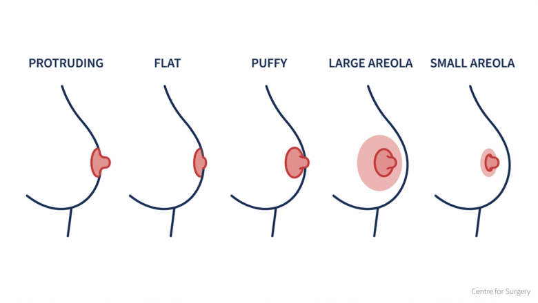 Diagram showing the normal range of nipple and areola variation: protruding, flat and puffy nipples and different areola sizes