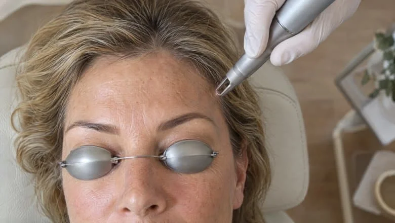 Overhead view of a laser handpiece over a faint blue temple vein, metal shields over the eyes, for periorbital vein removal in London