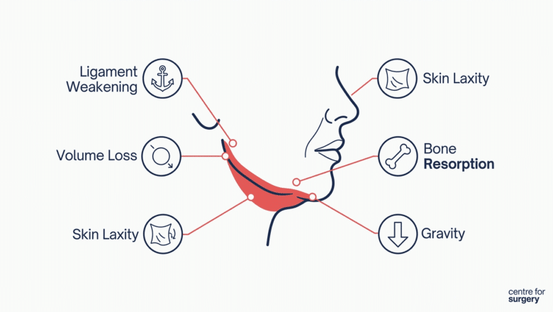 Side profile diagram of a sagging jowl jawline with five labelled causes: ligament weakening, volume loss, skin laxity, bone resorption and gravity, each shown with a simple icon and leader line