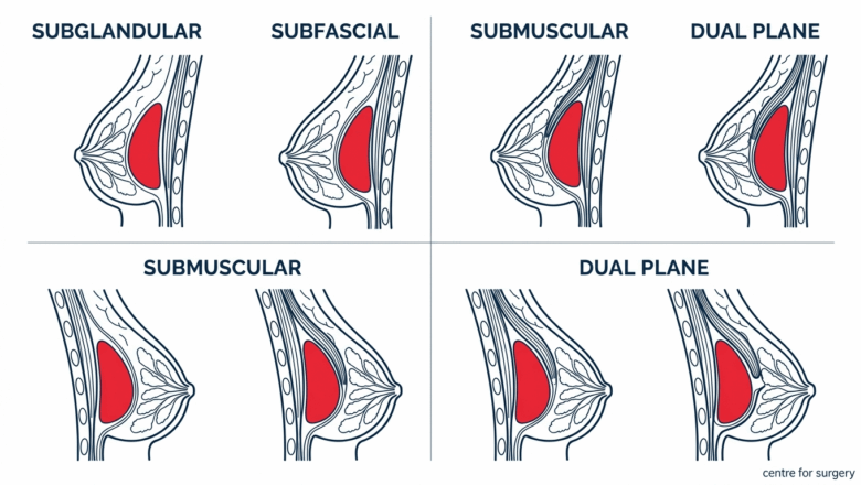 Four cross-section panels comparing subglandular, subfascial, submuscular and dual plane breast implant placement positions