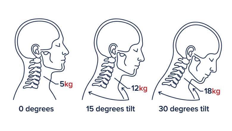Medical diagram showing how head weight increases with forward tilt angle from 5kg at neutral to 12kg at 15 degrees and 18kg at 30 degrees