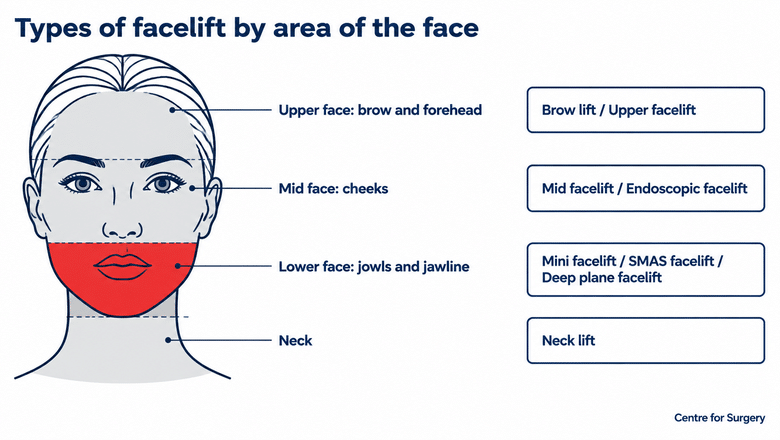 Diagram of the types of facelift by area of the face: brow lift or upper facelift for the brow and forehead, mid facelift or endoscopic facelift for the cheeks, mini facelift, SMAS facelift or deep plane facelift for the jowls and jawline, and neck lift for the neck