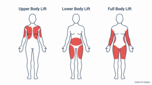 Diagram comparing upper body lift, lower body lift and full body lift zones on the body at Centre for Surgery London