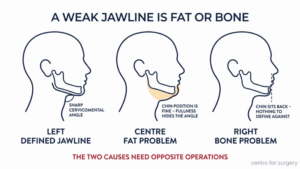 Diagram comparing a defined jawline with the two causes of a weak jawline — a fat pad beneath the chin blurring the cervicomental angle, and a chin that sits too far back behind the lower lip line