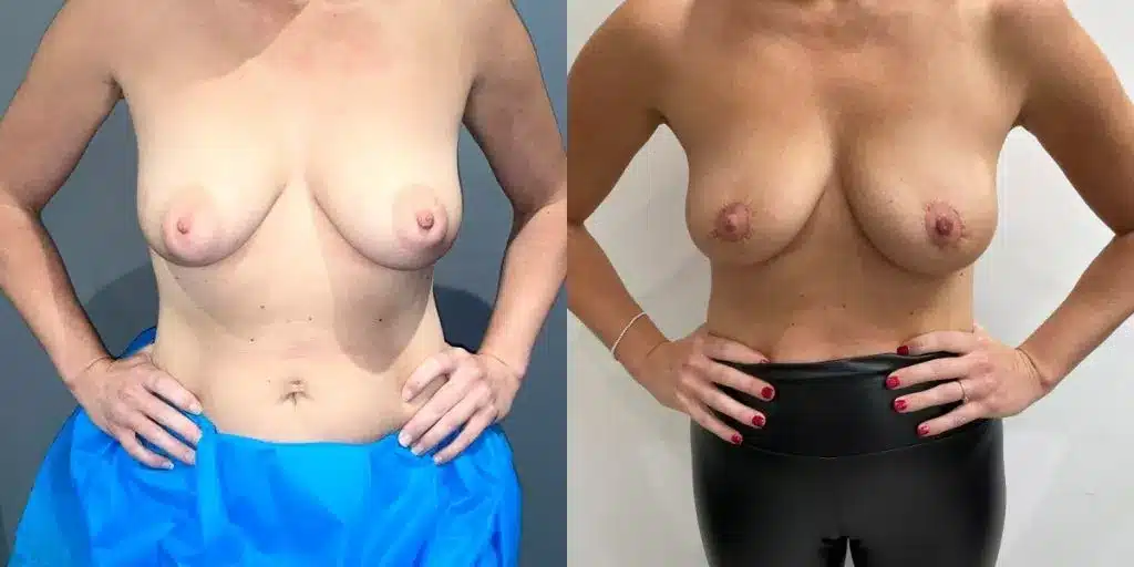 Areola reduction before and after, result 7