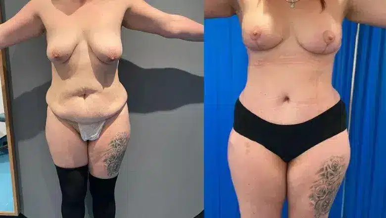 Mummy makeover before and after, result 12