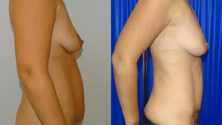 Mummy makeover before and after, result 20