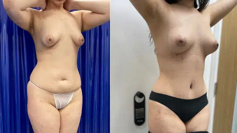 Mummy makeover before and after, result 9