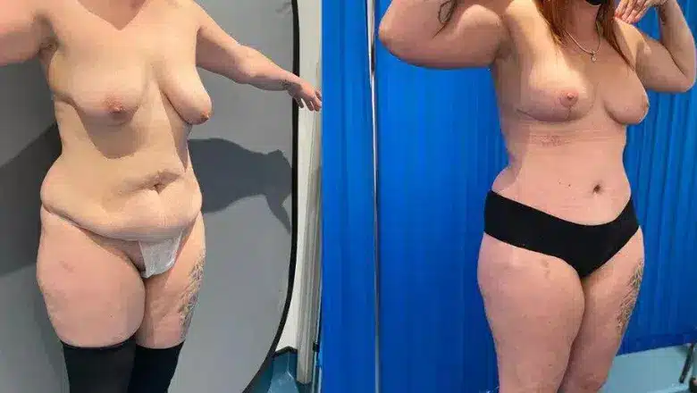 Mummy makeover before and after, result 14