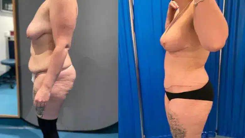 Mummy makeover before and after, result 15