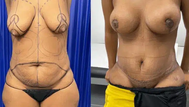 Mummy makeover before and after, result 11