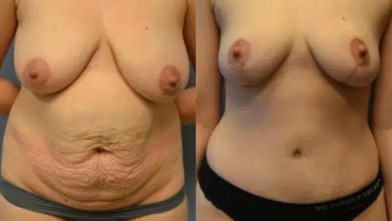Mummy makeover before and after, result 6