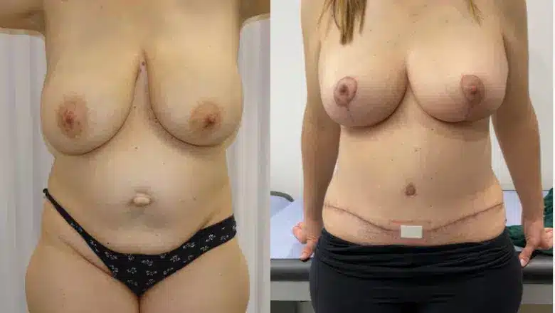 Mummy makeover before and after, result 17