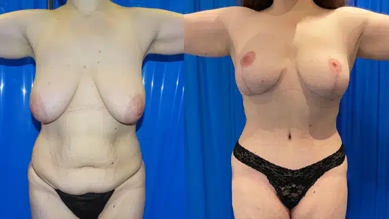 Mummy makeover before and after, result 1