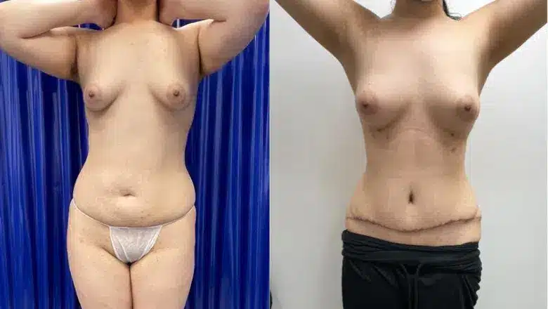 Mummy makeover before and after, result 7