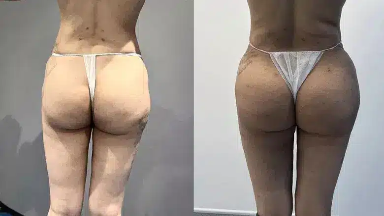 Brazilian butt lift (BBL) before and after, result 22