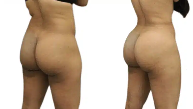 Brazilian butt lift (BBL) before and after, result 5