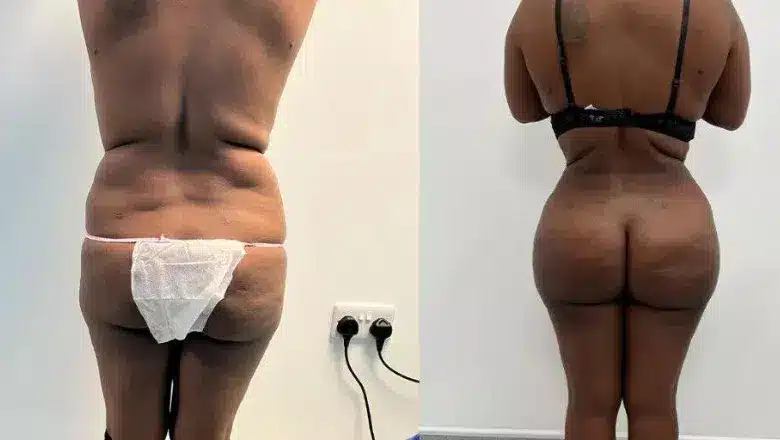 Brazilian butt lift (BBL) before and after, result 20