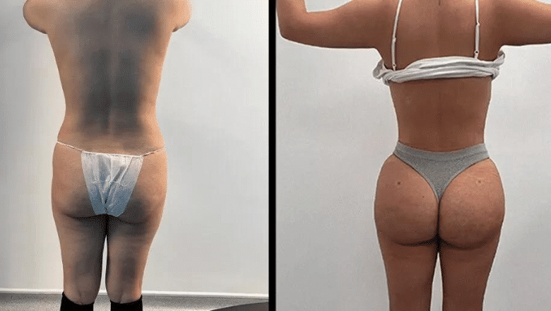 Brazilian butt lift (BBL) before and after, result 14