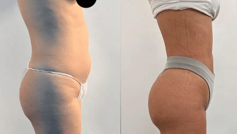 Brazilian butt lift (BBL) before and after, result 15