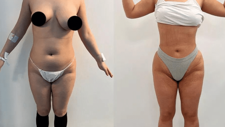 Brazilian butt lift (BBL) before and after, result 16
