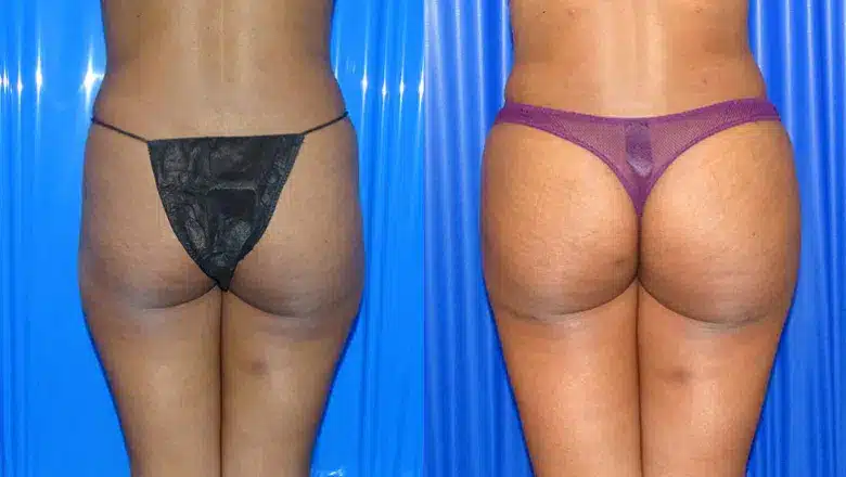 Brazilian butt lift (BBL) before and after, result 25